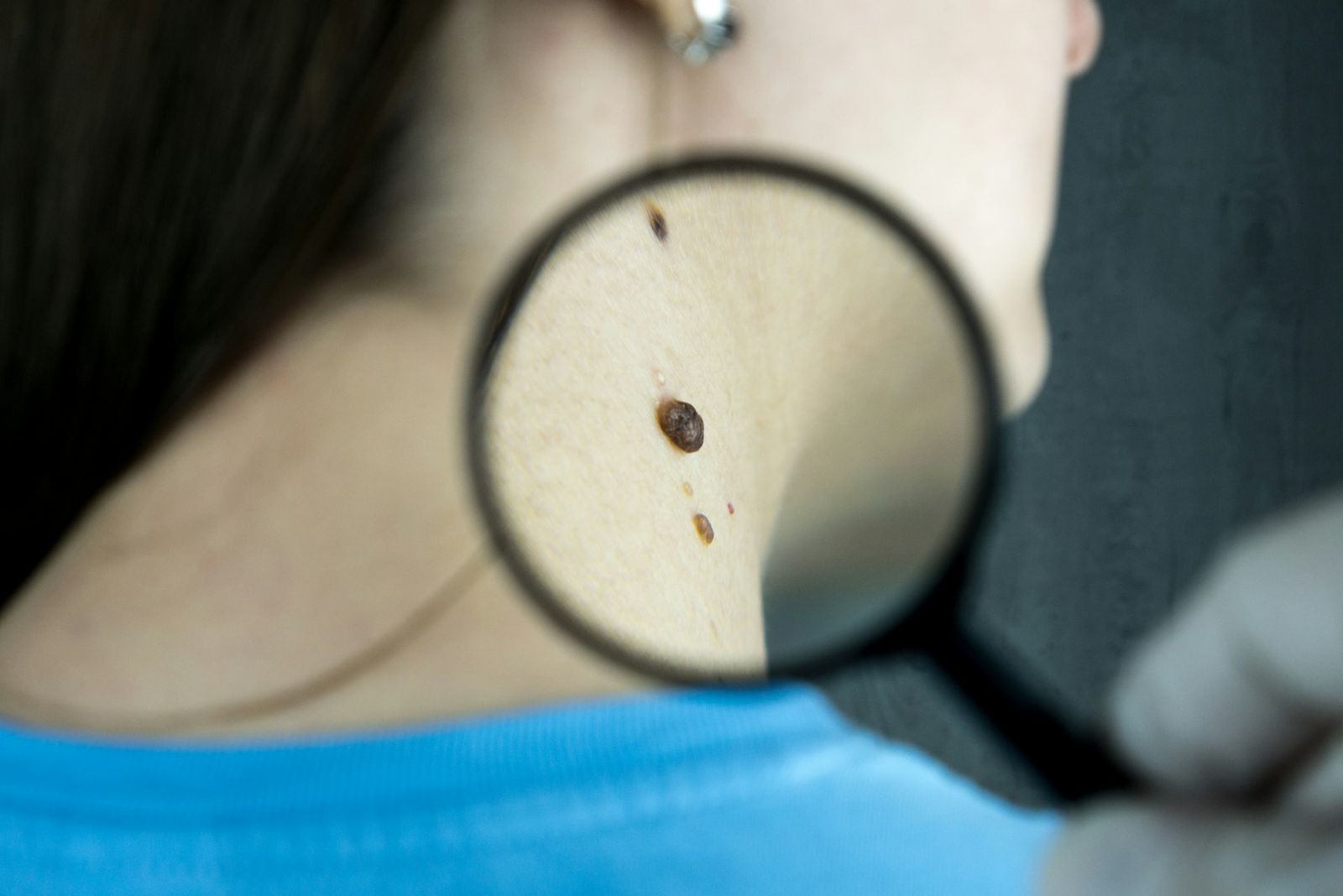 Dermatologist examining a patient's skin with a magnifying glass